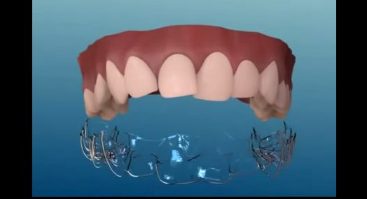 Además de los brackets hay otra opción para mejorar la sonrisa, y es invisible (Video)