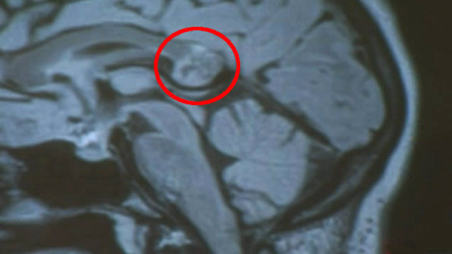 La mujer que vivió con un gemelo malvado en su cabeza… pues no era un tumor, era un embrión