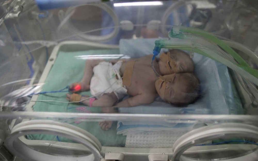 ¡OMG! Dos siamesas con dos corazones en un sólo cuerpo nacieron este miércoles en Gaza