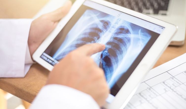 Crearon en Australia una tecnología no invasiva para diagnosticar el cáncer de pulmón