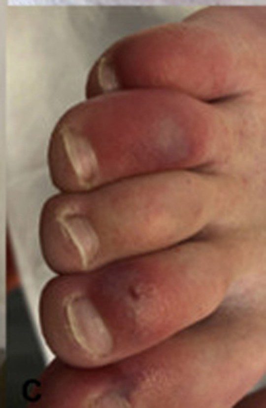 Dedos hinchados o morados, un nuevo síntoma del Covid-19 (FOTOS)
