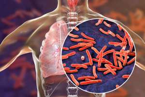 CDC  investiga extraño brote de tuberculosis por posible medicamento contaminado en EEUU