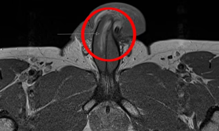 Médicos estudian el primer caso del mundo de una fractura vertical de pene