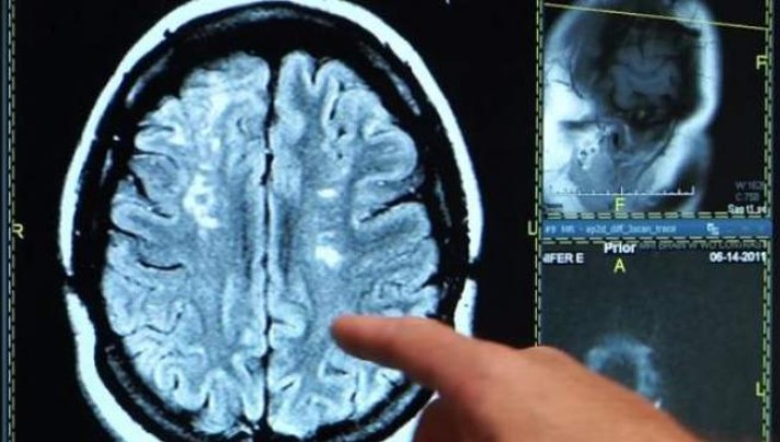 El extraño caso de una masturbación que acabó en derrame cerebral