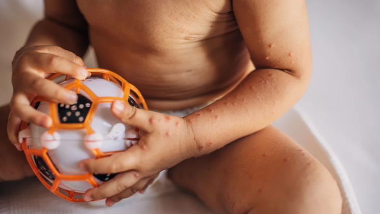 OMS insta a una respuesta urgente contra el sarampión para proteger a millones de niños en Europa