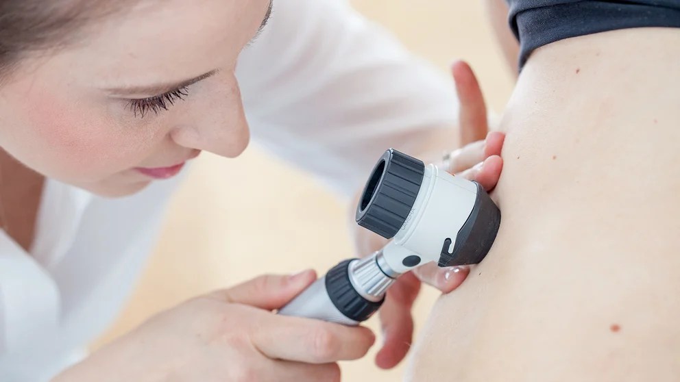 Melanoma: cuidado de la piel, autoexamen y control dermatológico, las tres claves de la prevención