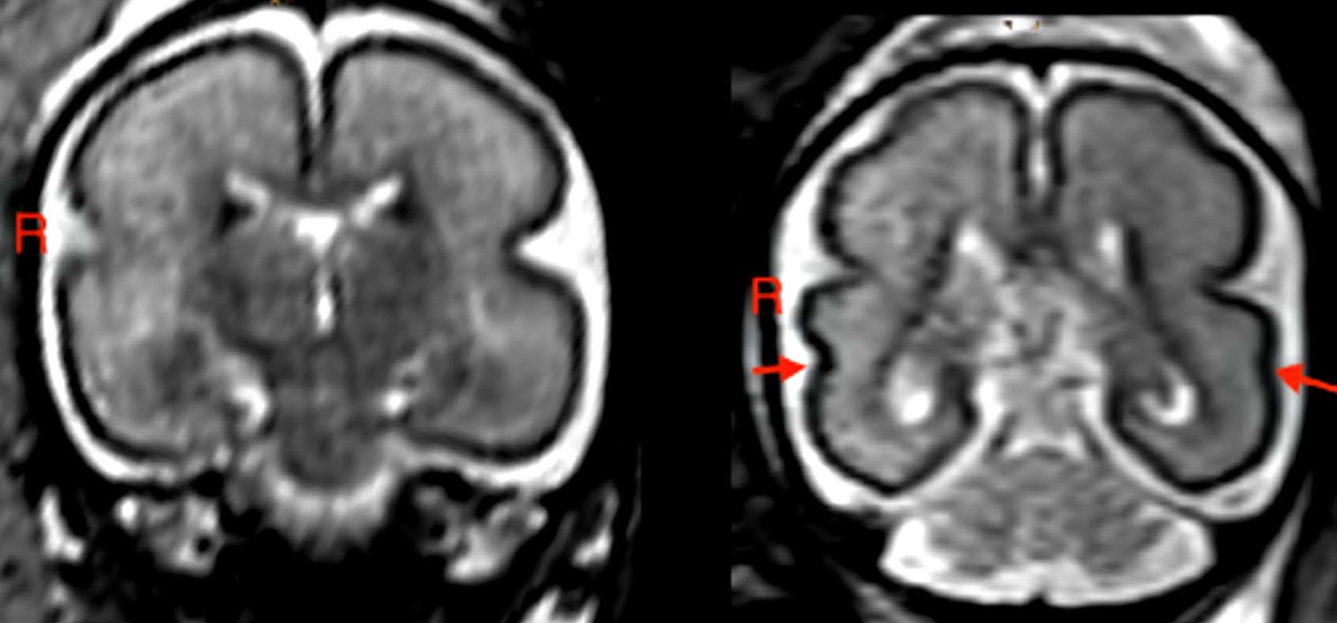 Beber en el embarazo, incluso poco, produce cambios en el cerebro del bebé