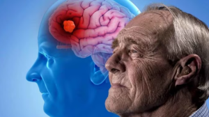 El signo en los ojos que puede estar relacionado con el alzhéimer